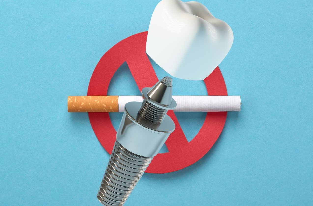 Cấy ghép Implant cho người hút thuốc: Có được không? Cần kiêng gì?